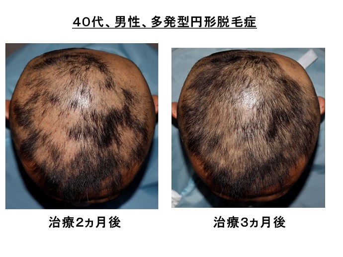 円形脱毛症　病院
